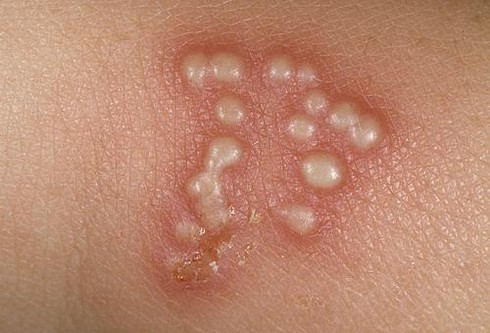Bệnh mụn rộp sinh dục và thai nghén - ảnh 1