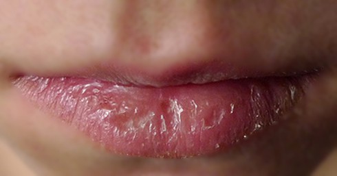 3 cách cực kỳ đơn giản khắc phục môi khô nẻ - ảnh 1