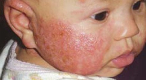 Bệnh chàm ở trẻ sơ sinh - ảnh 1