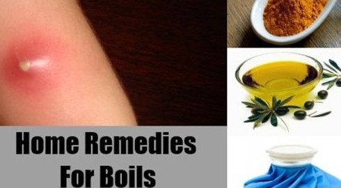 7 mẹo trị nhọt cực hiệu quả và dễ làm - ảnh 1