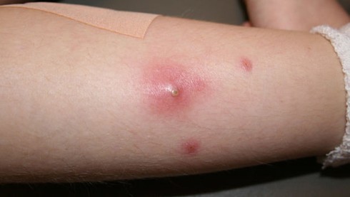 7 mẹo trị nhọt cực hiệu quả và dễ làm - ảnh 2