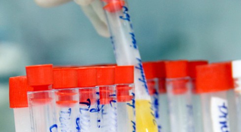 Dấu hiệu viêm đường tiết niệu - ảnh 1