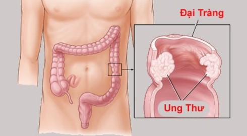 Ung thư đại trực tràng: Triệu chứng, nguyên nhân và cách phòng tránh - ảnh 1