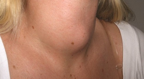 Basedow và những chú ý khi dùng thuốc - ảnh 1