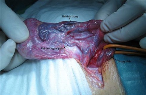 Có phải em đang bị giãn tĩnh mạch tinh? - ảnh 1