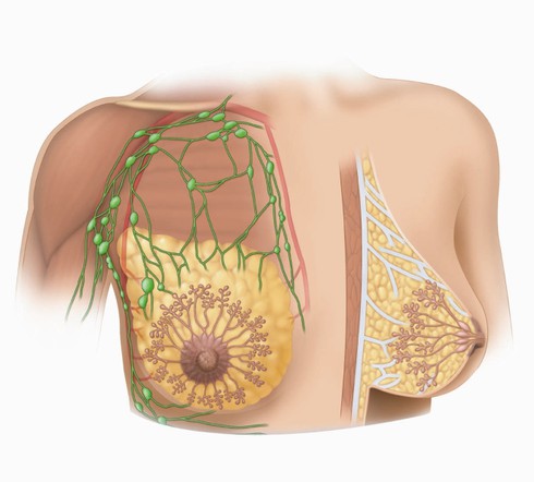 Hoang mang khi bác sĩ chẩn đoán nang sữa tuyến vú, nách có hạch - ảnh 1
