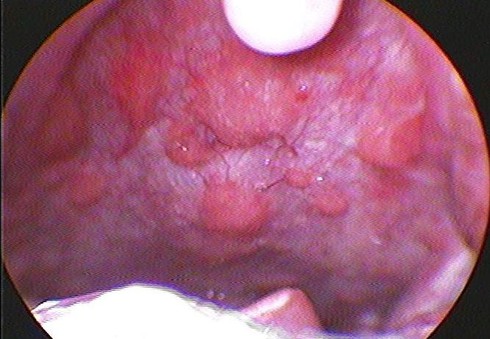 Nguyên nhân bất ngờ gây viêm họng - ảnh 1