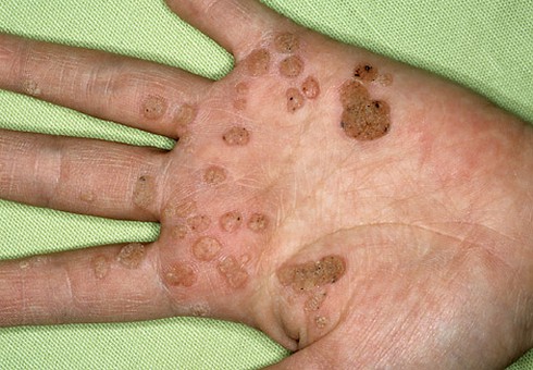 Các phương pháp điều trị mụn cóc - ảnh 1