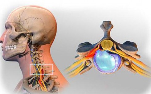 Đau vai cổ gáy mạn tính: Những thói quen gây bệnh - ảnh 1