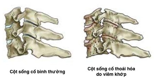 Đau vai cổ gáy mạn tính: Những thói quen gây bệnh - ảnh 2