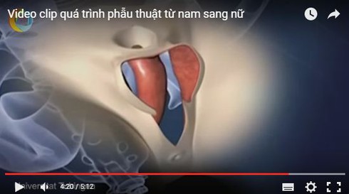 Video quá trình phẫu thuật dương vật thành âm vật - ảnh 1