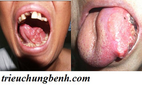 Tạo lưỡi mới cho bệnh nhân ung thư lưỡi - ảnh 1