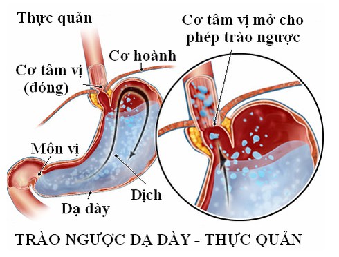 Những triệu chứng không thể bỏ qua của bệnh trào ngược dạ dày - ảnh 1