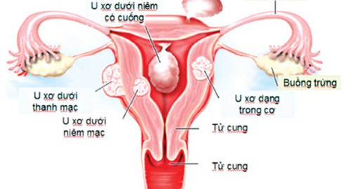 U xơ tử cung 3mm có đáng lo ngại? - ảnh 1