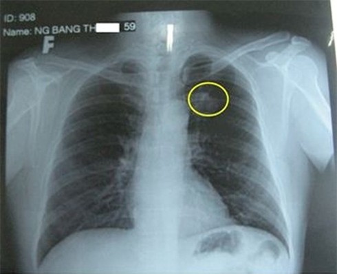 Phát hiện u phổi, làm sao để biết có phải ung thư không? - ảnh 1