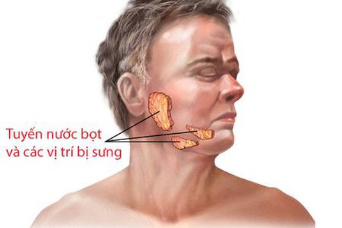 Dấu hiệu mắc quai bị - ảnh 1