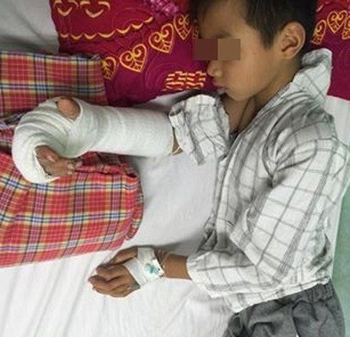 Nối bàn tay bị đứt gần lìa cho bé trai 8 tuổi - ảnh 1