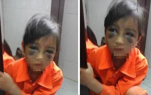 Cô giáo đánh học sinh tím mặt: Cảnh cáo hoặc buộc thôi việc - ảnh 1