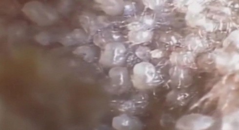 Kinh hoàng phát hiện ổ ve ký sinh trong tai người - ảnh 1