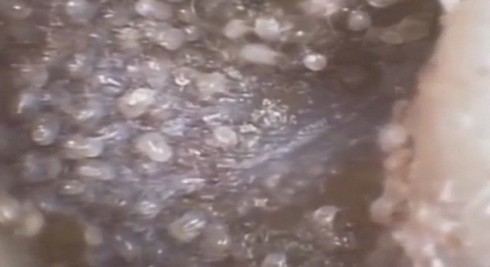 Kinh hoàng phát hiện ổ ve ký sinh trong tai người - ảnh 2