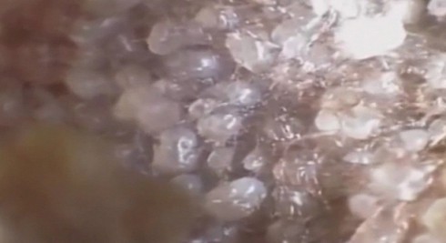 Kinh hoàng phát hiện ổ ve ký sinh trong tai người - ảnh 3