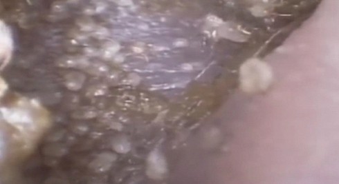 Kinh hoàng phát hiện ổ ve ký sinh trong tai người - ảnh 4