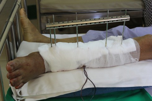 Quảng Ninh:Nối thành công cẳng chân bị đứt rời do máy cắt cỏ - ảnh 1