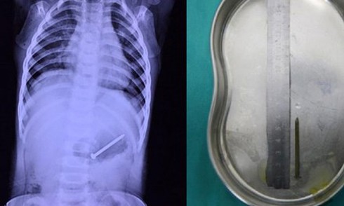 Nội soi gắp cây đinh vít 2cm kẹt trong thực quản trẻ 2 tuổi - ảnh 1