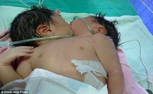 Cặp sinh đôi dính liền nụ hôn khiến các bác sỹ bó tay - ảnh 2