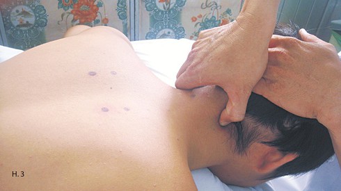 Xoa bóp chữa đau vai gáy do tư thế - ảnh 3