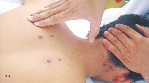 Xoa bóp chữa đau vai gáy do tư thế - ảnh 4