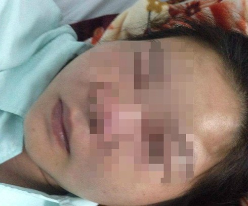 Nhiễm trùng, suýt chết vì nặn mụn ở mũi - ảnh 1
