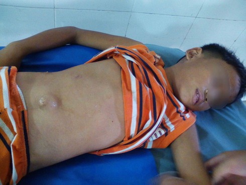 Đi xe đạp thả 2 tay, học sinh lớp 3 bị té dập gan - ảnh 1