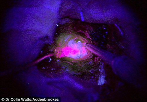 Khối u phát quang: Triển vọng chữa ung thư