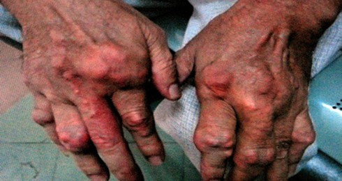 Đã có bệnh viện riêng cho bệnh nhân Gút