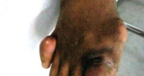 Đã có bệnh viện riêng cho bệnh nhân Gút