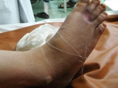 Chớ xem thường tiền đái tháo đường