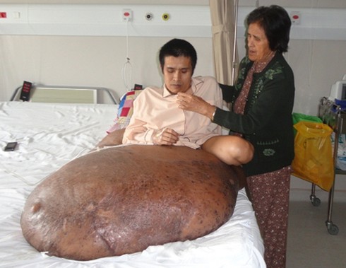 Phẫu thuật khối u khổng lồ đã thành công