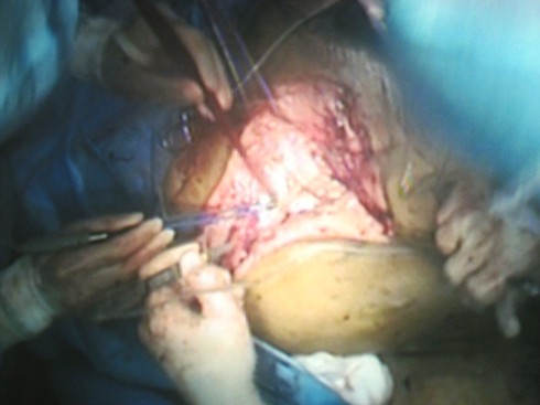 Phẫu thuật khối u khổng lồ đã thành công