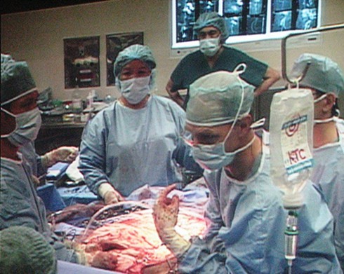 Phẫu thuật khối u khổng lồ đã thành công