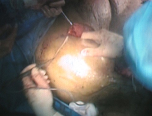 Phẫu thuật khối u khổng lồ đã thành công