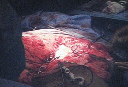 Phẫu thuật khối u khổng lồ đã thành công