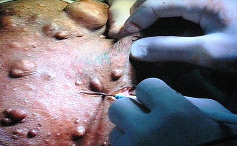 Bác sĩ tách khối u khổng lồ `tái sinh` cho hai phụ nữ dị dạng