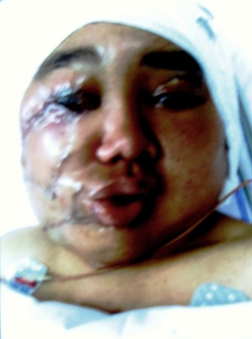 Hai bệnh nhân u bướu dị dạng đã có `diện mạo` mới