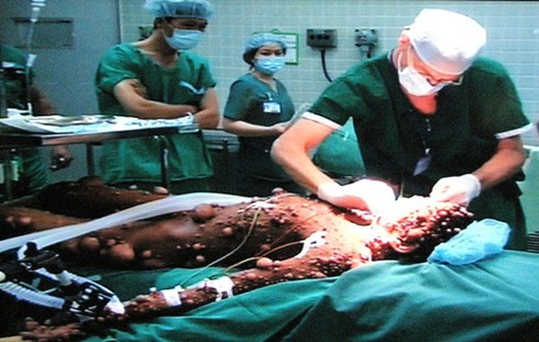 Hai bệnh nhân u bướu dị dạng đã có `diện mạo` mới