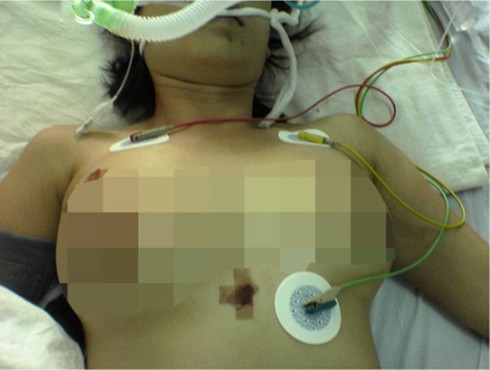 Suýt chết vì bơm silicon nâng ngực