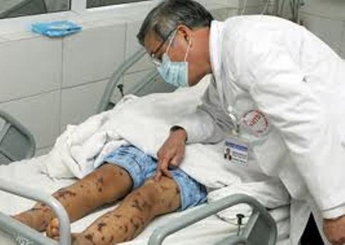 TP.HCM: Dịch não mô cầu đã lan rộng ra cộng đồng