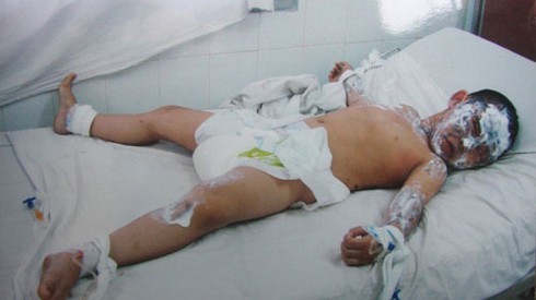 Vụ gia đình bị tạt a xít: Nạn nhân nguy kịch