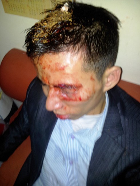 Nợ 320 triệu đồng, bị đâm vào mắt, đánh ngất tại chỗ