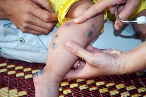 Đà Nẵng: Bé 2 tuổi tử vong vì bệnh tay chân miệng